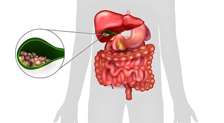 Colecistitis y cálculos biliares