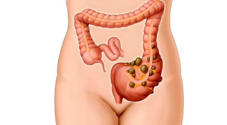 Diverticulitis aguda