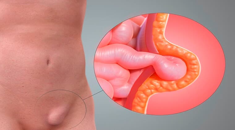 Hernias abdominales, inguinales, umbilicales