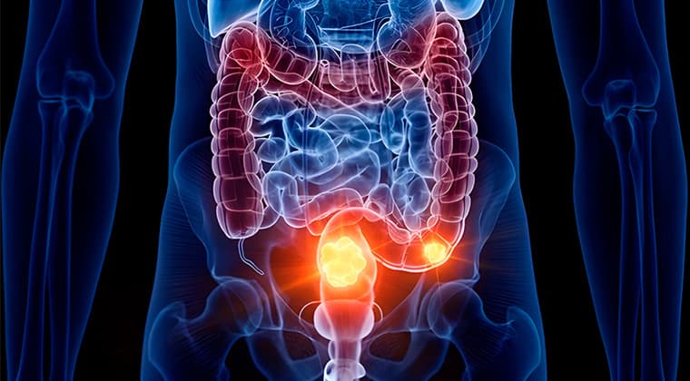 Obstrucción intestinal