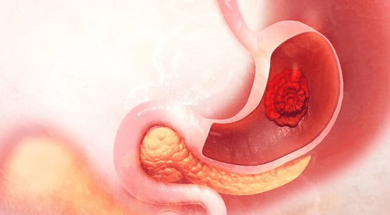 Úlceras gástricas y duodenales