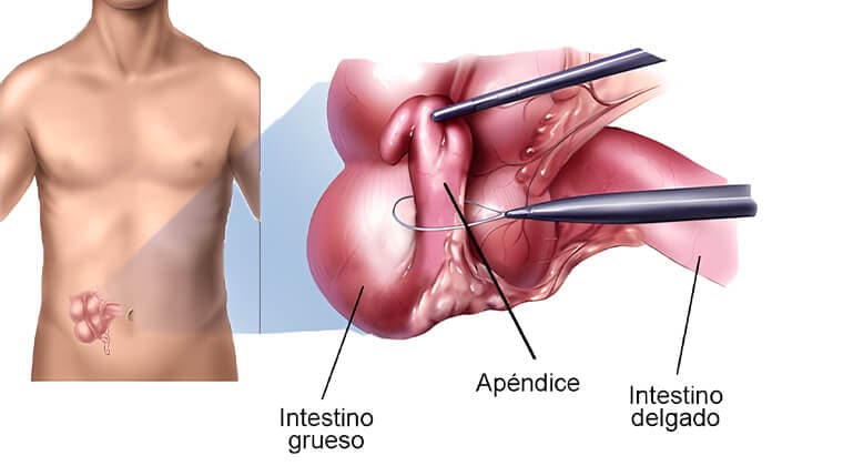 Apendicectomía