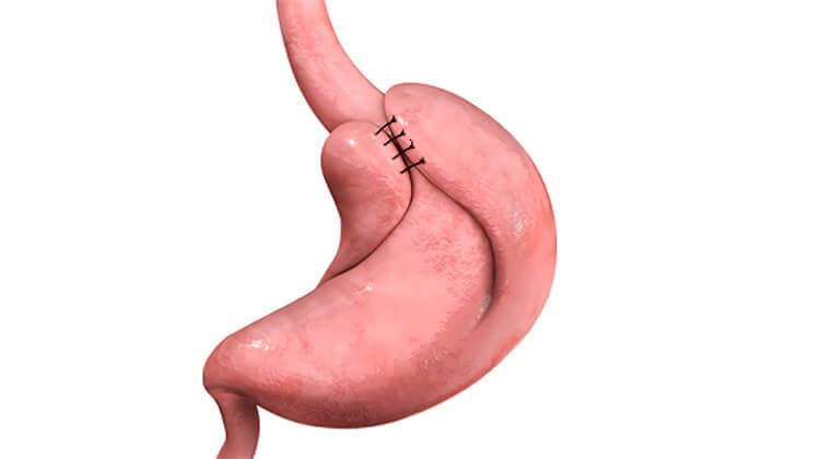 Cirugía antirreflujo (funduplicatura de Nissen)