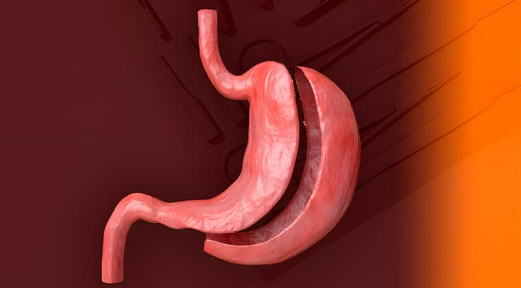 Gastrectomía parcial/total
