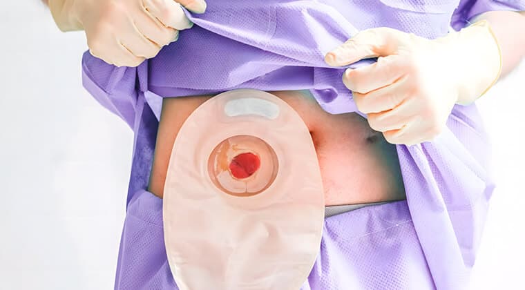 Manejo de ostomías