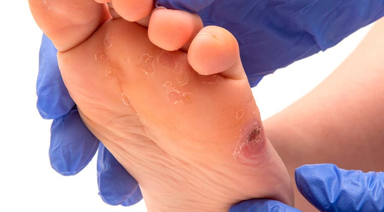 Manejo de pie diabético