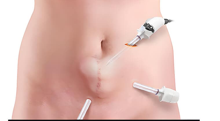 Reparación de hernias