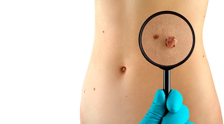 Resección de tumores benignos