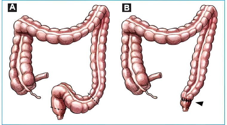 Resecciones intestinales